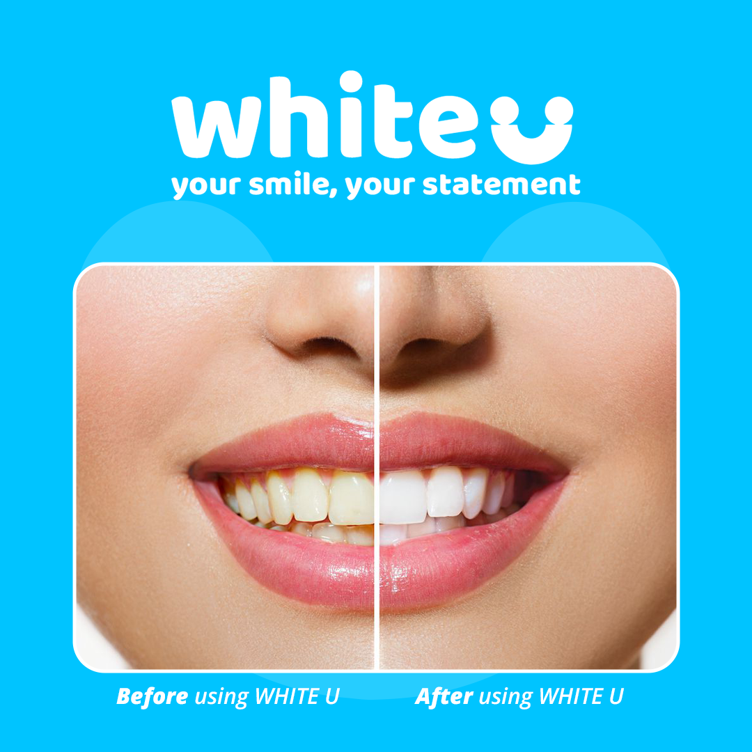 WhiteU teeth whitening strips applied to teeth during treatment
